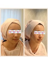 アンジェリカ(Angelica)/老化肌を引き締め小顔に