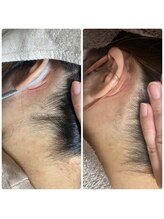 ゼロ 水戸店(ZERO)/うなじ脱毛★before&after