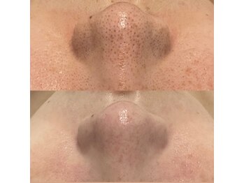 ミューズ(MUSE)/毛穴エクストラクション