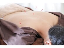 アカリコ鍼灸(Akariko鍼灸)/お身体の施術