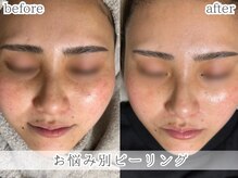 ミック(Mecc)の雰囲気(お肌のお悩みに合わせ4種類の中からお選び頂けます★)