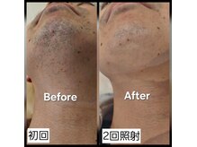  Before・After写真 