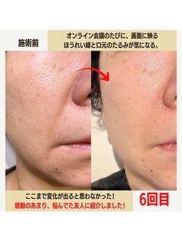 経堂鍼灸整体院/幹細胞美容鍼+小顔矯正