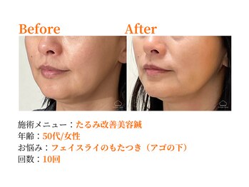 シルエラバレ(CiruelaValle)/Before After