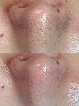 グリーン(green)/毛穴空っぽ♪