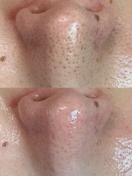 グリーン(green)/毛穴空っぽ♪