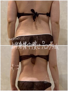 OBS新潟整骨院/脂肪冷却で失敗しないダイエット