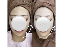 ウルス(ulus)/LC式美輪郭小顔