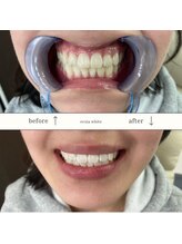 エクシアホワイトニング 沖縄宮里店/お客様ビフォア