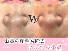 フェイシャル/エステ/脱毛/顔脱毛/フェイシャルワックス/