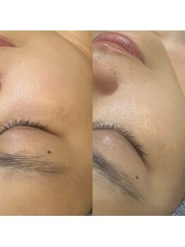 アルム(a'rme)/【くすみコース】