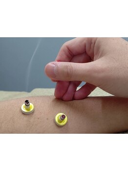 鍼灸施術を受けたい