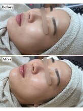 ソワナ(soina)/【神楽坂駅/フェイシャル/毛穴】