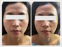 恵比寿脱毛 シーズ(She’s)/ソフトダーマ30代ビフォア