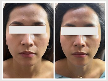 恵比寿脱毛 シーズ(She’s)/ソフトダーマ30代ビフォア