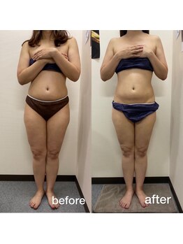 リラクラージュ(Ri Ra Courage)/ 30代3ヶ月後