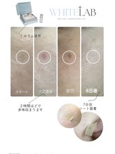 Kino Beauty Salon二子玉川店 ローマピンク/ホワイトラボ/脂肪冷却/シミ/メラニンケア/ホワイトラボ