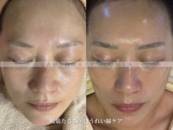 ルミア(LUMIA)の写真/もっときれいになりたい貴女へ！お肌の土台からきれいをサポート◎憧れの透明感あふれるハリツヤ美肌へ＊