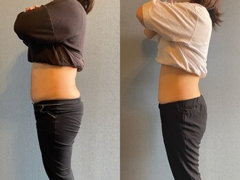 クリアリティ ボディ ケア(clearity body care)/2ヶ月間のビフォー＆アフター♪