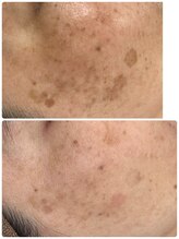 エクシア(excia)/ダウンタイムなし！シミケア