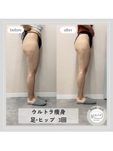 カラー(CALLA)/冷えむくみ改善◎ウルトラ痩身