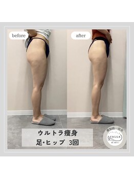 カラー(CALLA)/冷えむくみ改善◎ウルトラ痩身