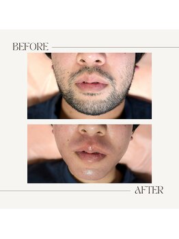 スプランドゥール(Splendeur)/メンズ【ひげ】WAX+光