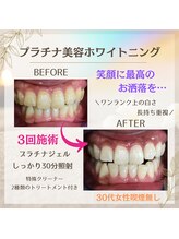 ホワイトニングプラス(Whitening+)/プラチナ美容ホワイトニング