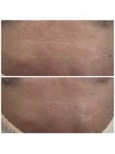 アネラ キキ サロン(anela kiki salon)/美肌肌質改善VOSサロンケア