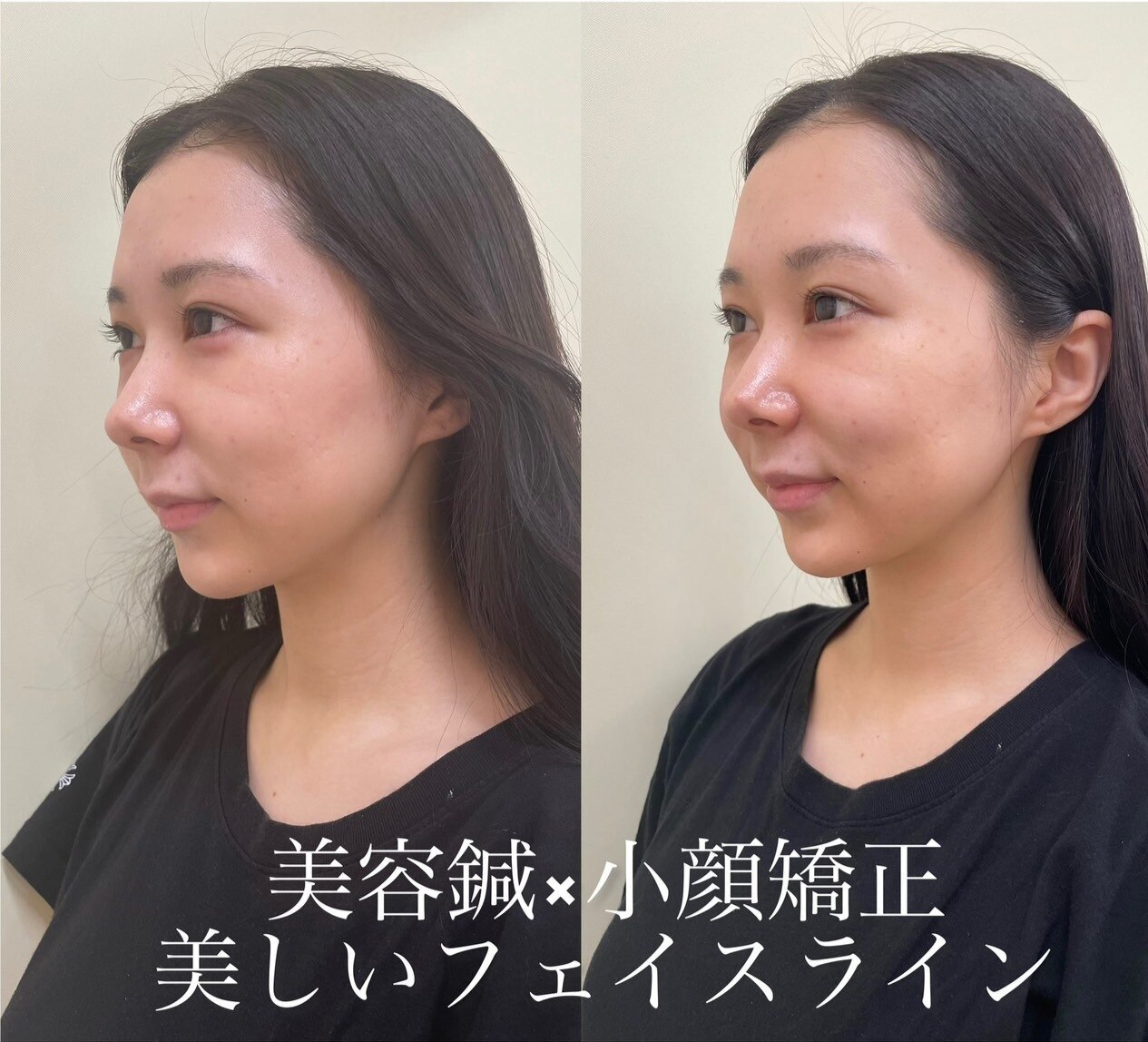 美容鍼灸≪むくみスッキリ小顔≫まずは一度お試し！【即効性◎美容鍼】\5,980