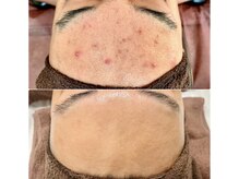 イロドリ(irodori)/エクソソームハーブピーリング♪