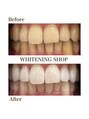 ホワイトニングショップ 福岡春日店&nbsp;#ホワイトニング#ホワイトニング福岡#美白 #セルフ #最新美容