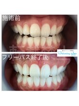 ホワイトニングサロン 福岡天神店/ホワイトニング