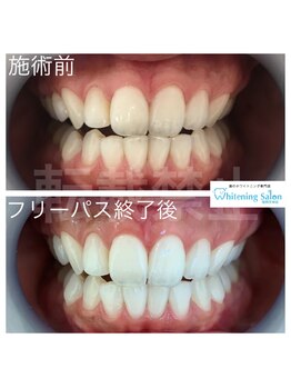 ホワイトニングサロン 福岡天神店/ホワイトニング