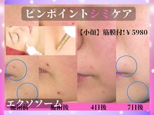 【シミしわ改善】にも特化した専門店です。ピンポインで【シミケア】プラス小顔リフトアップ筋膜リリース付