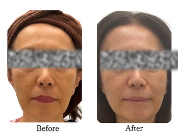 ラディアント たまプラーザ/スノーピール×サーマトリックス