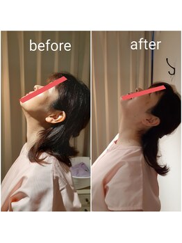 エルアンドエス(L&S)/頚の可動域のビフォーアフター