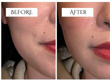 クク 赤坂 天神(99 KUKU)/【ほうれい線】【頬のもたつき】