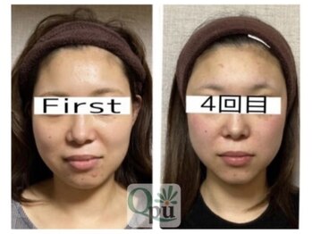 キュープ 小倉店(Qpu)/通常コース4回での変化