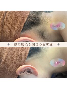 スターチス(Statice)/襟足脱毛