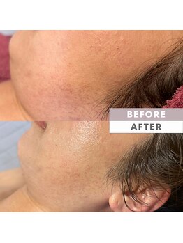 とぅるりん 肌質改善/ほほのくすみ、ざらつきにも♪