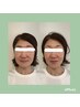 【たるみ/しわ改善】最新小顔リフト＋パック&美容液仕上げ