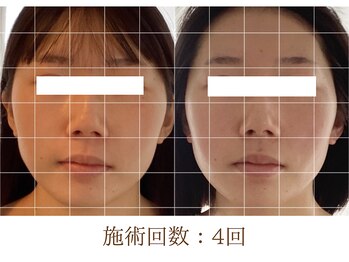 アンスリウム(ansrium)/