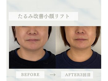 ソラ(Sola)/たるみ改善小顔リフト
