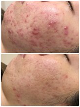 アンジェロ/【ニキビケア】肌育プログラム