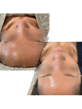 ウィズ(with)/REVIハーブピーリング×白玉WAX