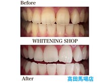 フリーパス終了時/ホワイトニング専門店/ホワイトニング高田馬場