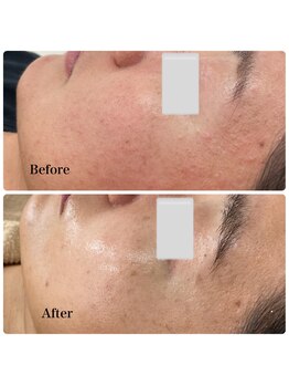 モスト(MOST)/エンビロンフルコース+毛穴洗浄