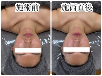 シェミー(CHEZ MEE)/小顔/透明感/潤い/毛穴/くすみ