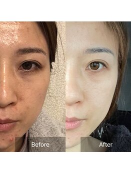 サロン ド アヤ(salon de Aya)/月2回施術で4ヶ月後の変化